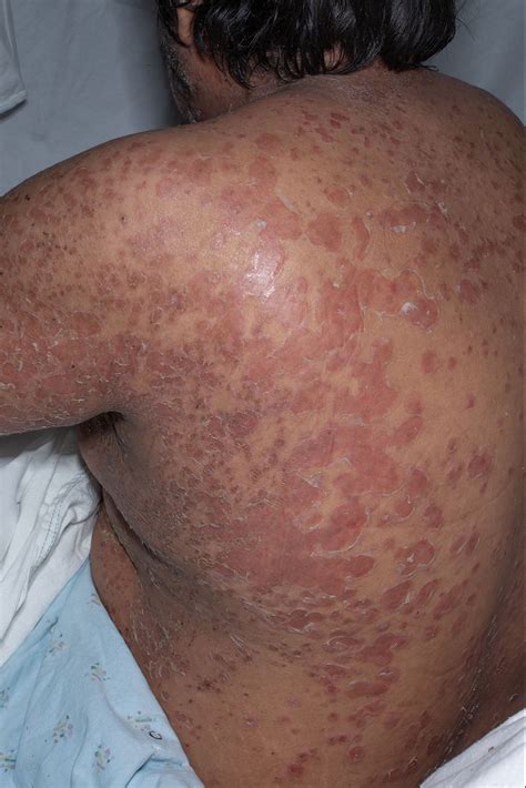 Pregabalin and the possible risk of bullous dermatitis and