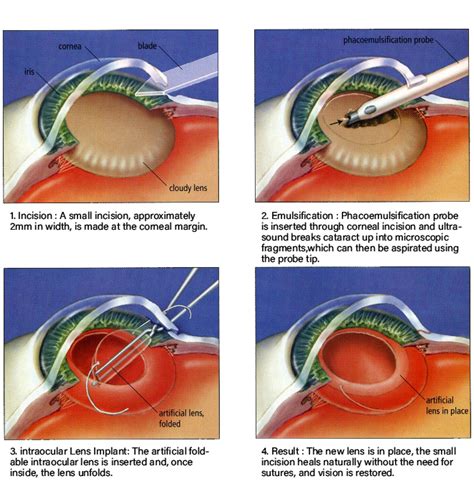 Premium cataract surgery a step by step guide. - Sony kdf 60xbr950 70xbr950 service manual.