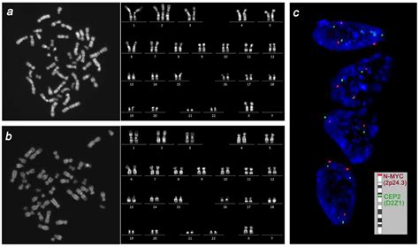 Prenatal Detection of Trisomy 2: Considerations for …