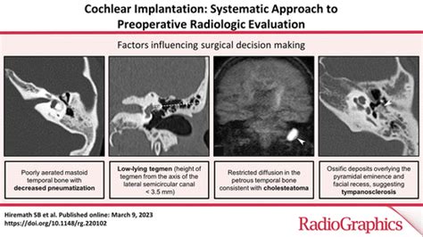 Preoperative Assessment of Multichannel Cochlear Implant …