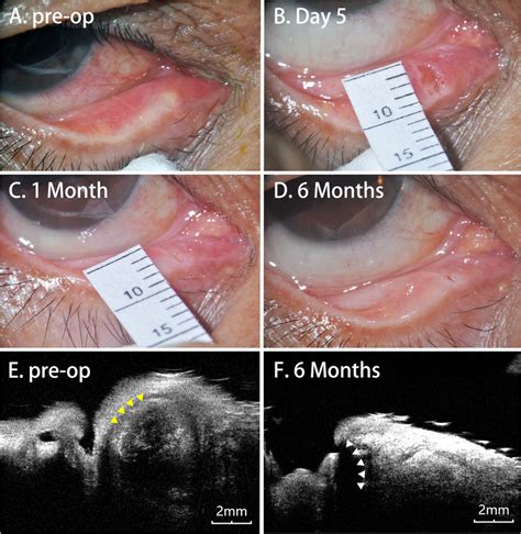 Preoperative and postoperative changes in the wound and UBM findings. A