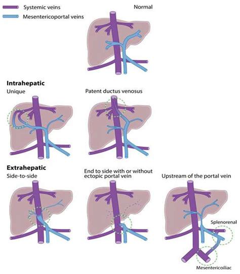 Presentation of Congenital Portosystemic Shunts in Children - MDPI