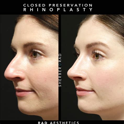 Preservation Rhinoplasty: Open or Closed? - PubMed