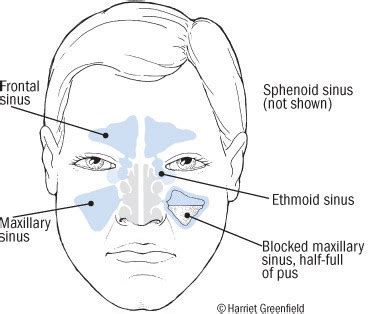 Pressure in nose when bending over