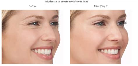 Preventative Botox