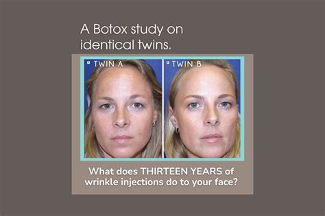 Preventative Botox in Twins Study Omnisculpt