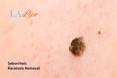 Preventing Seborrheic Keratosis