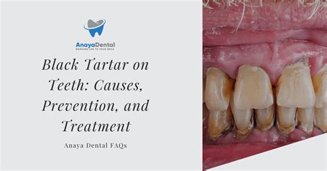 Preventing black gums.  To prevent tartar from developing on your teeth, you...