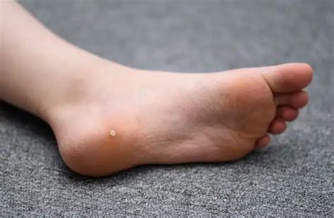 Preventing the Spread of Plantar Warts: A Guide for Athletes and …