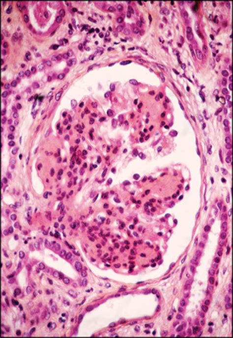 Prevention of lithium-associated renal failure: recent evidence