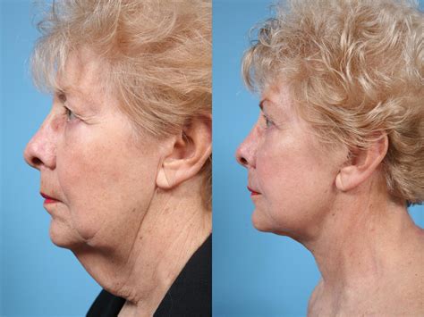 Price Of A Neck Lift