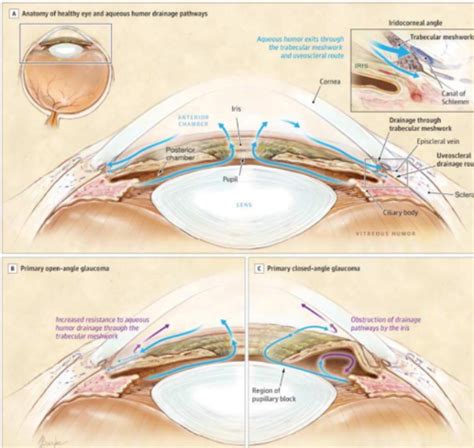 Primary Angle Closure / Primary Angle Closure Glaucoma (PAC …