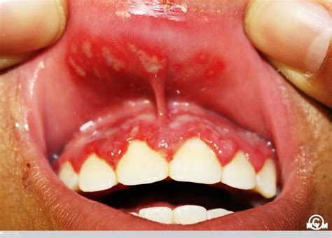 Primary Herpetic Gingivostomatitis [en5k029jypno]