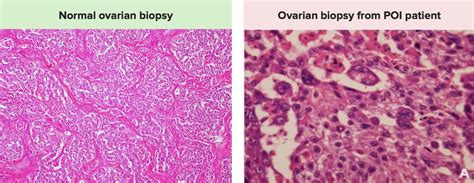 Primary Ovarian Insufficiency Concise Medical Knowledge