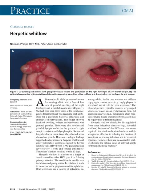 Primary and recurrent herpetic whitlow - PubMed