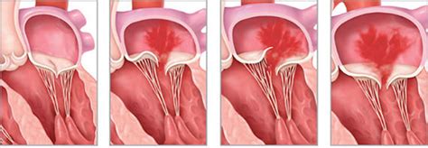 Primary vs. Secondary Mitral Regurgitation: 5 Facts to …