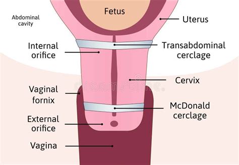 Printable Cervix Diagrams HD 101 Diagrams