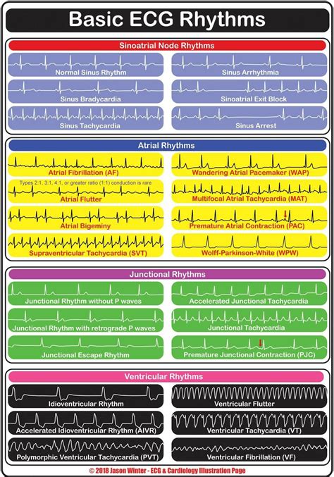 Printable ekg rhythms. ECG (EKG) examples and quiz . For each of the questions below a short clinical scenario is given followed by the 12-lead ECG. Review the ECG (EKG), present it according to the structure in ECG interpretation and attempt a diagnosis before clicking on the plus symbol to see the answer. Question 1. A 35 year old man presents with palpitations. 