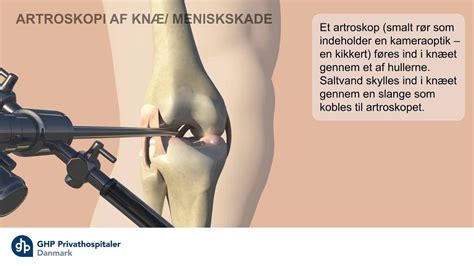 Problem efter meniskoperation