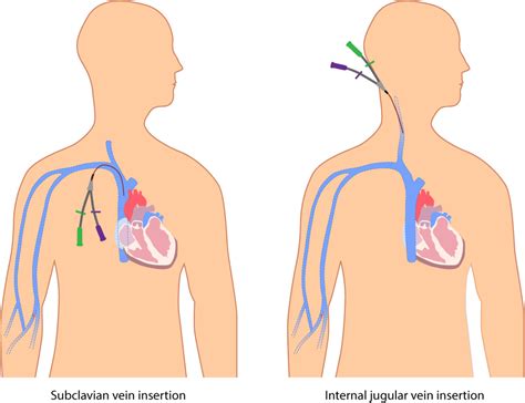 Procedure: Removal of Central Venous Catheters (Jugular