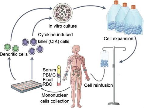 Procedure for CIK preparation and infusion. Peripheral blood...