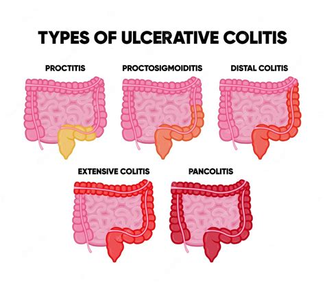 Proctitis Ulcerative Colitis Forums Patient