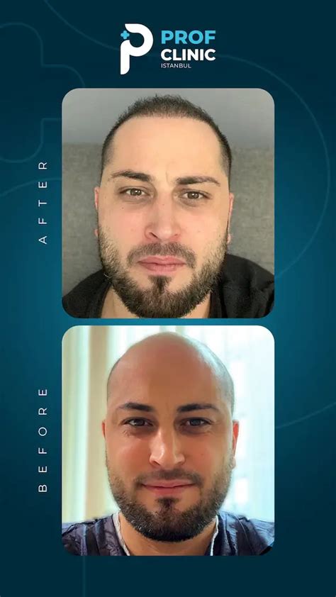 Prof Clinic Turkey: Hair & Dental Implants in Istanbul. 