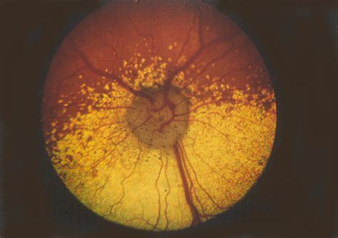 Progressive Retinal Atrophy, Rod-Cone Dysplasia 4