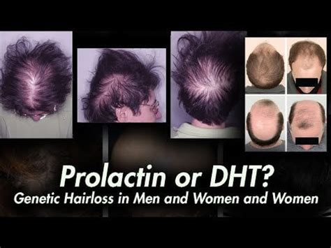 Prolactin dht reddit.  DHT destroys the follicle.  [&ndash;] Accurate-Muffin9650 [S] 0 points1 point...