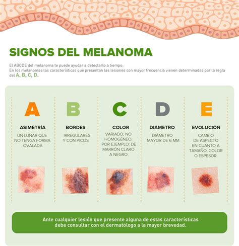 Pronóstico del melanoma 3 mm.