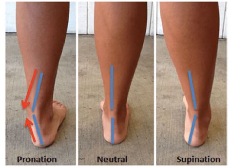 Pronation Overpronation Supination Causes and Solutions
