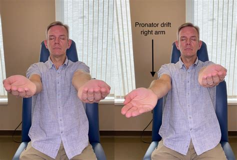 Pronator drift. Jun 5, 2010 · Testing for pronator driftThe patient extends their arms in front of them with the palms up and eyes closed. The examiner watches for any pronation and downw... 