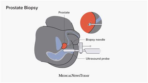 Prostate Biopsy Procedure What You Should Know