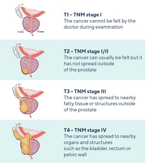 Prostate Cancer Stage What Does it Mean Everyday Health