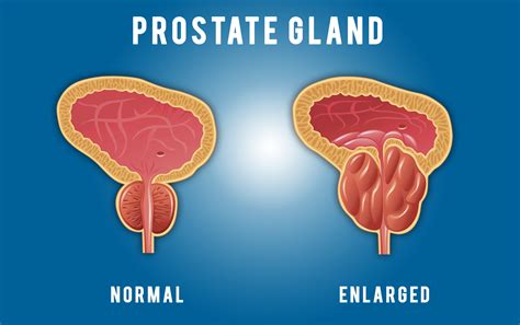 Prostate related urinary problems - Treatment for an enlarged