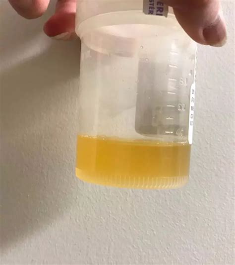 Protein in urine while pregnant