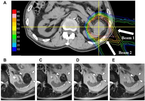 Proton Therapy for Primary Renal Cell Carcinoma: The First