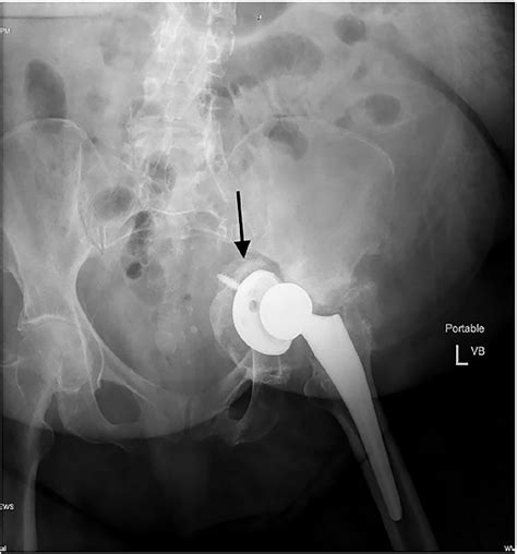 Protruding screw? : r/Radiology