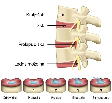 Protruzija diska iskustva.  Za optimalnu terapiju hernije/protruzije diska lumbalne...
