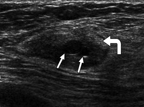 Pseudoangiomatous stromal hyperplasia Radiology …