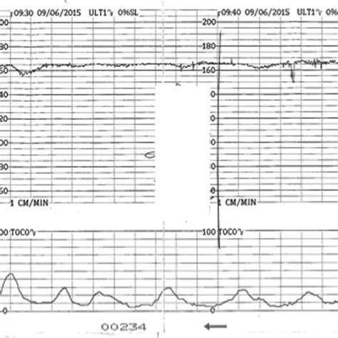 Pseudosinusoidal pattern. Note change to normal variability. Download
