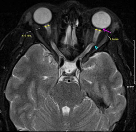 Pseudotumor cerebri syndrome: MedlinePlus Medical Encyclopedia