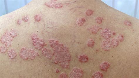 Psoriasis Rash: What It Looks Like and How to Deal - Greatist