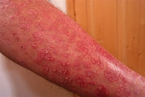 Psoriasis behandling