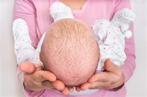 Psoriasis in babies: Symptoms and treatment