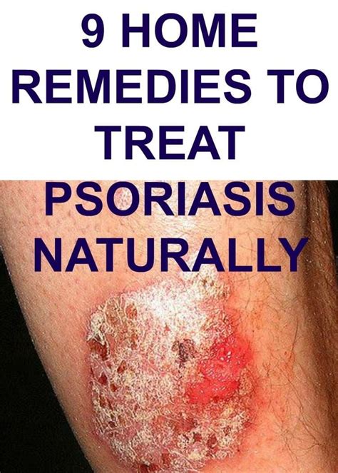 Psoriasis natural treatments remedies and cures your guide to psoriasis. - Przewodnik po zbiorach rękopisów w wilnie.