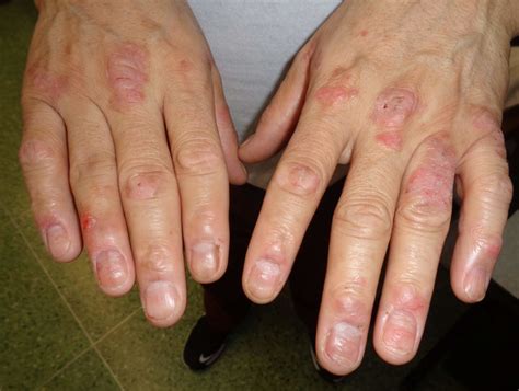 Psoriasis on just a few fingers?? - Dermatology - MedHelp