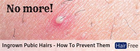 Pubic ingrown hair pictures. Ingrown hairs occur when a hair grows under the skin or curls around and grows directly into the hair follicle. Ingrown hairs commonly develop in areas subject to shaving or waxing, such as the ... 