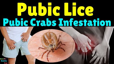 Pubic lice symptoms and treatment Be in the KNOW