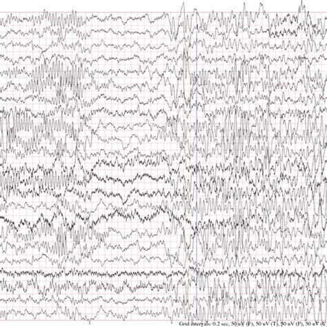 Public eeg datasets